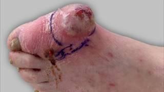 Draining pus from a foot infection