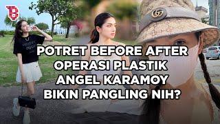 Potret sebelum dan sesudah Angel Karamoy operasi plastik mengaku belum puas hasilnya