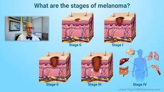 What are the stages of melanoma?