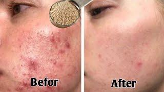 Quick treatment for facial acne - Acne treatment at home