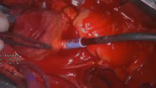 AsvideTotal aortic arch replacement for acute type A aortic dissection