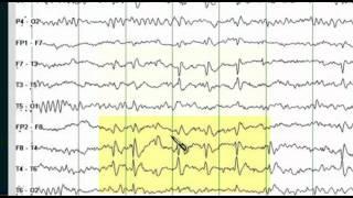 Focal EEG Abnormalities 1