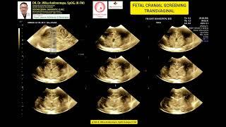 Transvaginal Fetal Cranial Screening