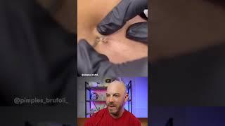 1010 pimple pop technique here #pimplepop #dermreacts #doctorreacts