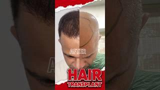 Hair Transplant Surgery 2-Year Transformation Journey  2 YEARS LATER UNBELIEVABLE RESULTS