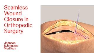 Effective Wound Closure Techniques in Orthopedic Surgeries Using DERMABOND  J&J MedTech