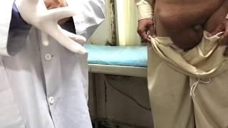 Hernia examination  inguinal hernia  inguinal scrotal swelling