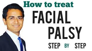 Facial palsy Bells Palsy Treatment Upper and Lower motor neuron UMN vs LMN Symptoms USMLE