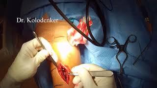 Distal Tibia Brodies Abscess Surgical Treatment