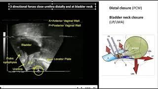 New surgical approach for stress Urinary incontinece - ISD