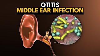 Middle Ear Infection Otitis Media Causes SIgns and Symptoms Diagnosis and Treatment.