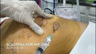 Sculptra filler treatment for hip dips - Ageless MD