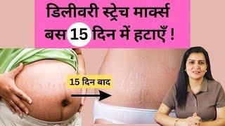 गर्भावस्था के स्ट्रेच मार्क्स हटाने के घरेलू नुस्खे  how to remove pregnancy stretch marks