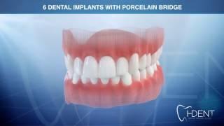 ALL on 6 dental implant procedure H-DENT