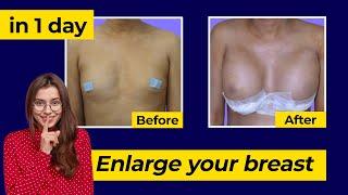 Best breast Augmentation Result  Breast implant 35 yrs Age Girl  breast Implant Surgery in Kolkata