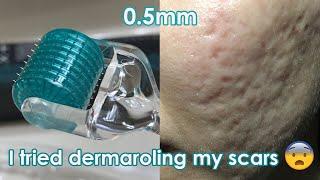 I tried dermarolling my ACNE SCARS  Demo + Review