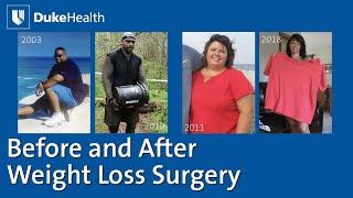 Before and After Weight Loss Surgery  Duke Health