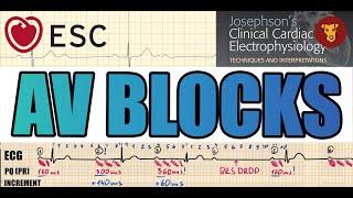 AV BLOCK ECG criteria HIS bundle electrogram site of origin managment Lyme carditis Erlanger ph