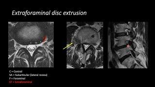 Lumbar Spine MRI by Eric Tranvinh MD Stanford Radiology