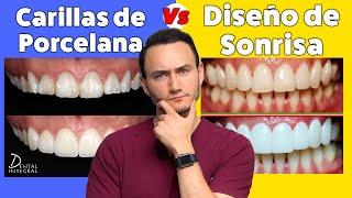 Carillas Dentales Vs Diseño de Sonrisa  Lo que tienes que saber antes de decidir