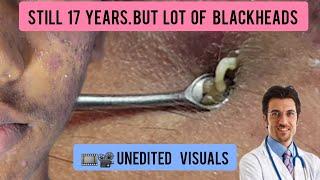 Blackheads extraction in a young male  #blackheads #blackheadremoval @Dr.AMAZINGSKIN