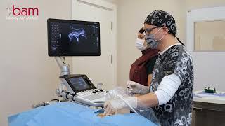 Ultrason Altında Transforaminal Epidural Enjeksiyon - Ultrasound guided transforaminal Injection