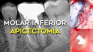 APICECTOMÍA DE UN MOLAR INFERIOR  CON LIMA ROTA. CIRUGÍA APICAL  CERCA DEL NERVIO DENTARIO