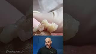 Volcanic pimple pop reaction #pimplepop #dermreacts #cystpop