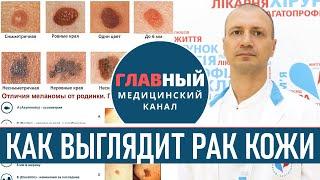 Как выглядит РАК КОЖИ фото 1-8. Меланома базалиома и плоскоклеточный рак кожи