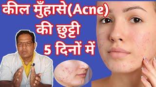 Pimple गायब हो जायंगे  adapalene and clindamycin phosphate gel  Cream For acne and Pimple