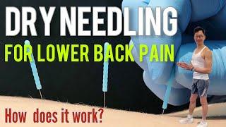 Dry Needling  Your Ultimate Solution for lower back pain