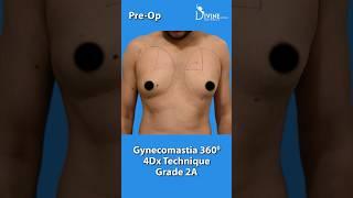Male Breast Reduction Surgery Result Grade 2A  Gynecomastia Surgery with 360°