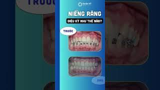 Thành Quả Sau Khi Niềng Răng #smileht#feedback#niengrang#niengrangmaccai #nhakhoasmileht