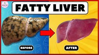 The Fastest Natural Methods to Reverse Fatty Liver  NAFLD Treatment revealed