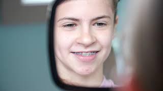 Make Your Teen Smile with Affordable Braces at Adirondack