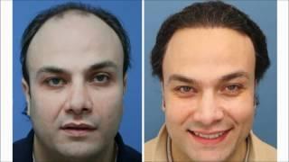 Do Hair Transplants Work Award Winning Surgeons