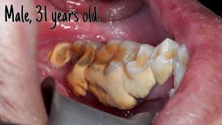 Half Jaw Quarter Hour Scaling  Dentist  Dokter Gigi Tri Putra