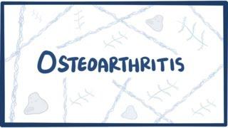 Osteoarthritis - causes symptoms diagnosis treatment & pathology