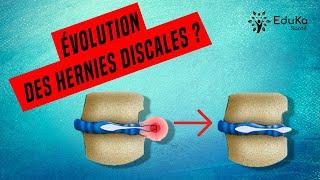 HERNIE DISCALE  ÉVOLUTION NATURELLE SANS TRAITEMENT