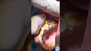خطوة بخطوة تركيب دعامات الأسنان وطربوش الأسنان post and core dental restoration