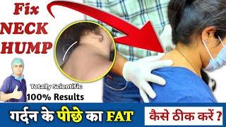 Neck Hump Exercises in Hindi  How to remove fatty Neck Hump  Dowagers hump Buffalo hump Exercise