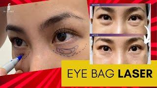 Non-Surgical Eye Bag Laser Treatment Say Goodbye to Under-Eye Bags