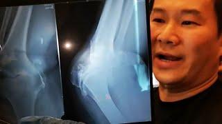 Chris Leong Tit Tar treat in Jakarta The patient X-ray shows that the knee is completely misaligned