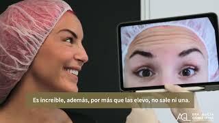 ¿Cómo eliminar arrugas de expresión?  Botox