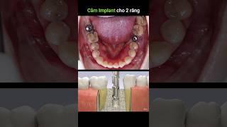 Cắm implant 2 răng 6-7. implant for 6&7 tooth #implant #dental #dentist