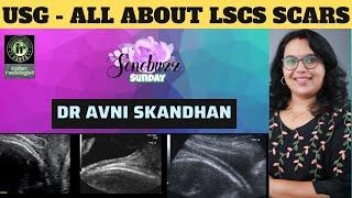 AVNI SKANDHAN  USG FOR LSCS SCAR INTEGRITY  CESAREAN SECTION  TVS ULTRASOUND  SONOBUZZ