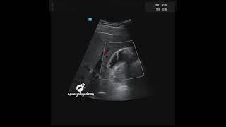 Gallbladder Adenomyomatosis