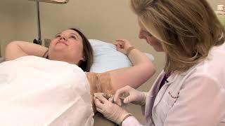 Botox for Underarm Sweating Hyperhidrosis - by Dr. Lori Stetler