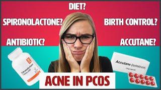 Acne treatment for PCOS Polycystic Ovarian Syndrome