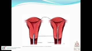 Hysteroscopy Consent